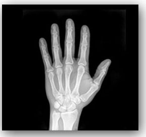 Hand X-ray shadow 2